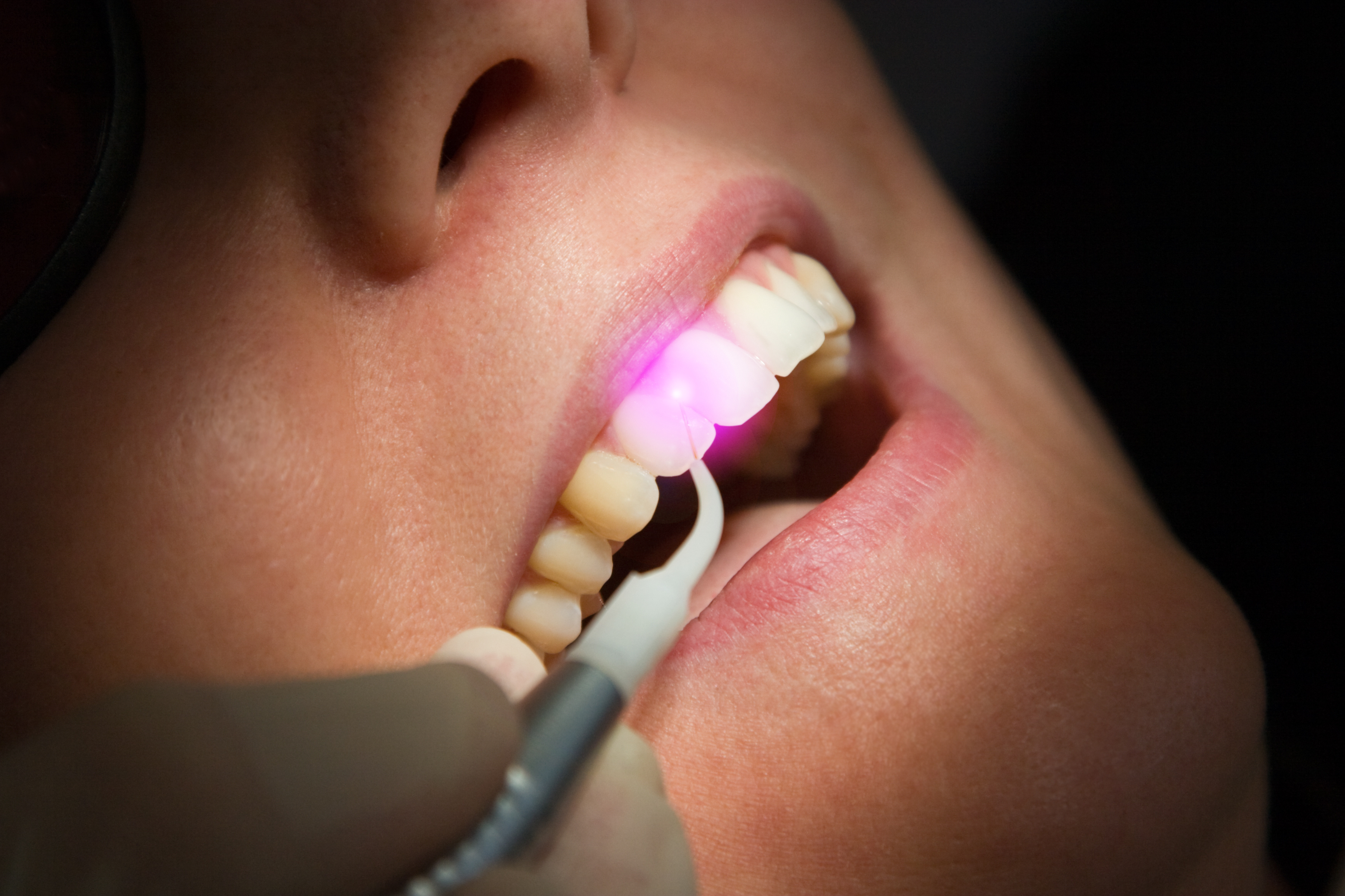 Dental Lazer Uygulamaları